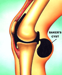 Bakers Cyst