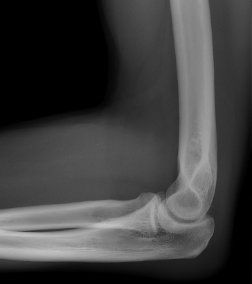 X-ray of the elbow 